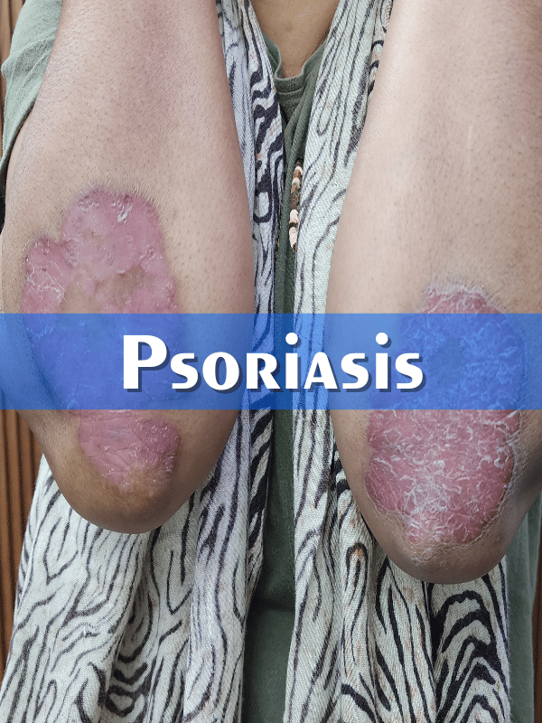 Psoriasis Treatment